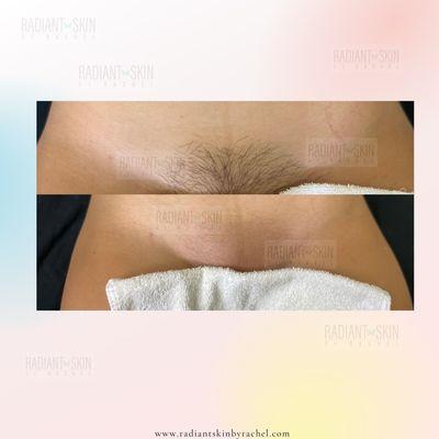 Before and after Brazilian wax