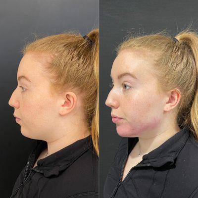 Facial balancing results with dermal fillers!