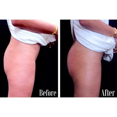 The Brazilian Butt Lift is our specialty.  It is a non surgical procedure to increase volume, shape and lift the butt.