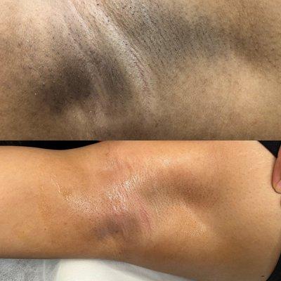 Laser Hair removal not only helps with removing unwanted hair and smooth out the skin but also it decreases skin blemishes and discoloration