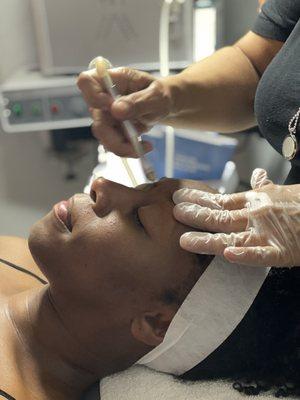 We also do Micro Dermabrasion