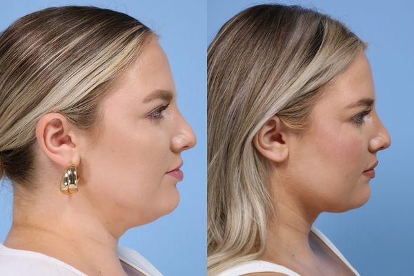 Nonsurgical skin tightening on woman from San Francisco