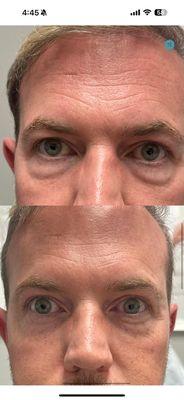 PRF treatment for under eyes