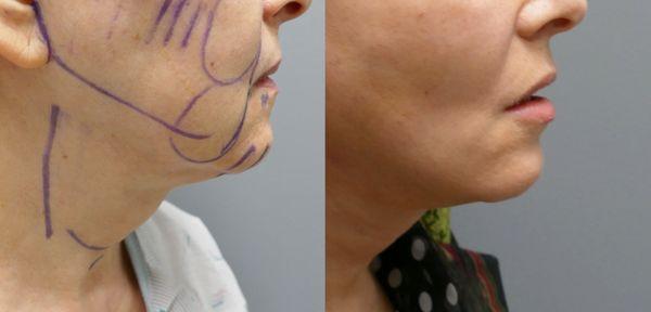 post microliposuction with fat grafts to chin