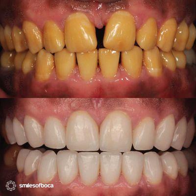 Porcelain Veneers