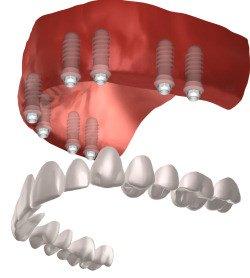 Full Arch of Metal Free Zirconia Dental Implants