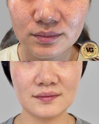 Skin brightening pigmentation correction laser.