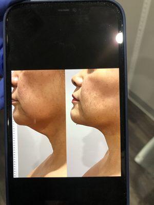 Before and after after one week. The jowls look smaller and neck slimmer. Still very swollen though, looks better now.