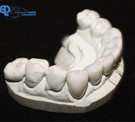 Porcelain veneers