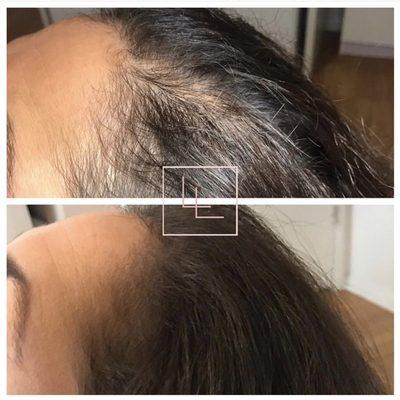 PRP Hair Rejuvenation