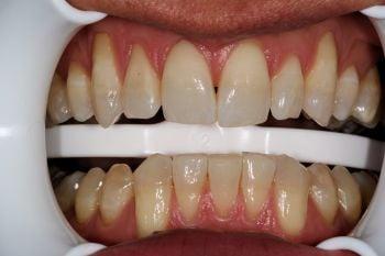 Tooth whitening
(before)