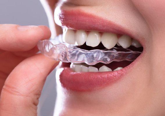 We use "Invisalign" clear braces in addition to conventional braces.