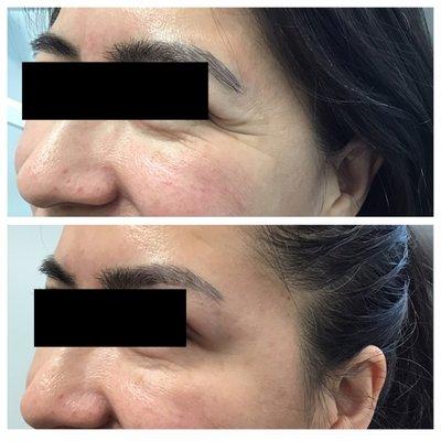 Crow's Feet in a young woman nearly eliminated with Botox