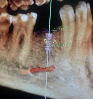 3D Xrays the top in technology are free of charge for Our Implant patients.