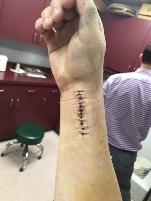 One week after surgery... such a great job on the incision!