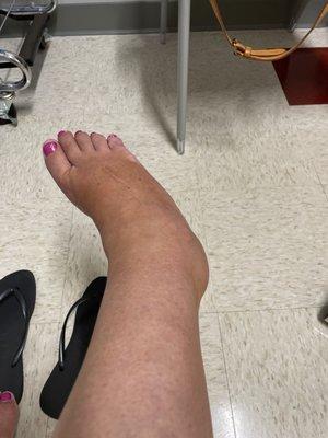 twisted ankle