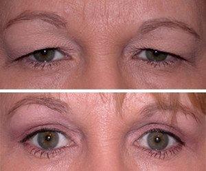 Upper and lower Blephoplasty (Eyelids)