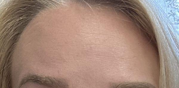 Forehead AFTER
Jeuveau treatment