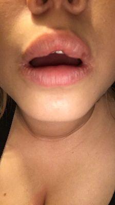 These are the lip fillers this place provides. AVOID