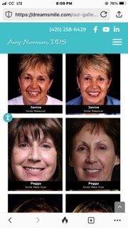 Me in my Before and After Treatment Photos in 2008, Age 52. My TMJ fixed, No Pain, given Beautiful Smile!