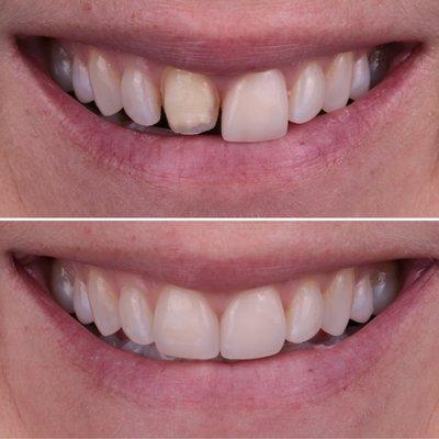 Two upper porcelain veneers