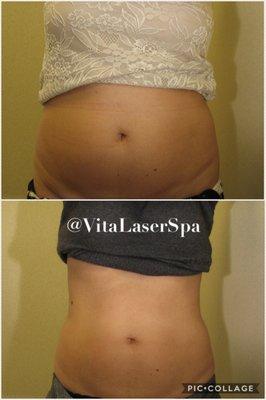 Cavi-Lipo before and after