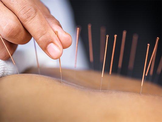 Orange County Acupuncture and Herbs helps to relieve pain and manage symptoms in a natural holistic way.