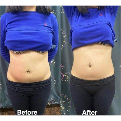 Ultrasound cavitation 
 Lose 1-2 inches per session