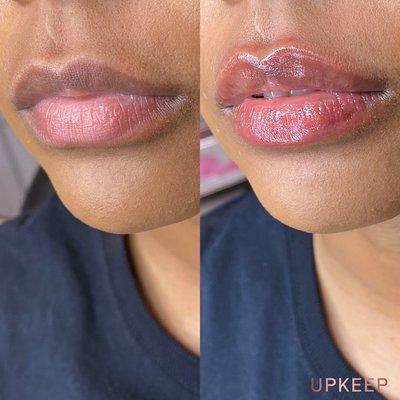 LIP FILLER