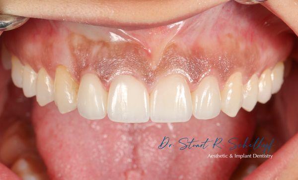 Just 4 veneers after orthodontics to improve her dental appearance