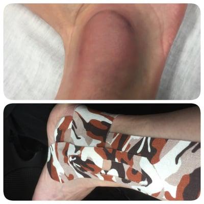 My ankle before and after Dr. Dave treated me