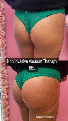 Non invasive BBL