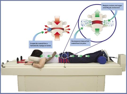 Spinal Decompression (VAX-D)