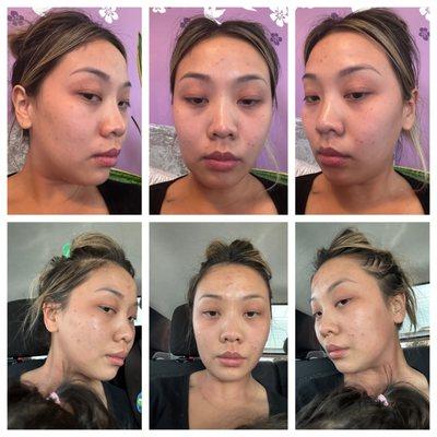 Pre/post facial