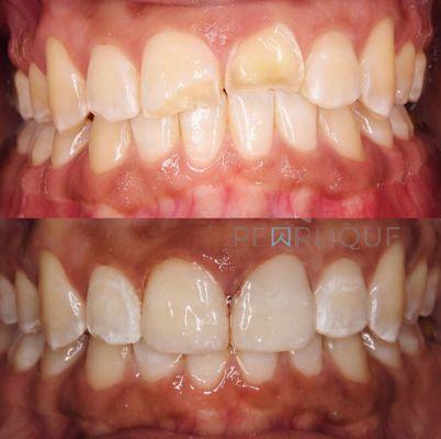 Same day treatment for teeth trauma