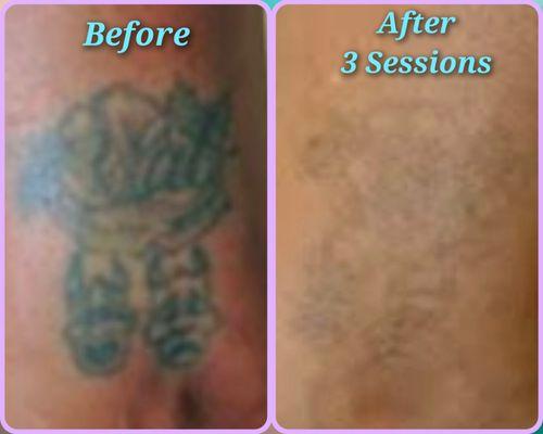 ATLasers Tattoo Fading & Removal