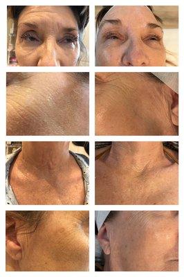 Microneedling