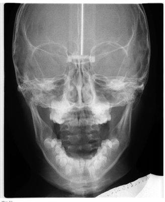 Open PA cephalometric