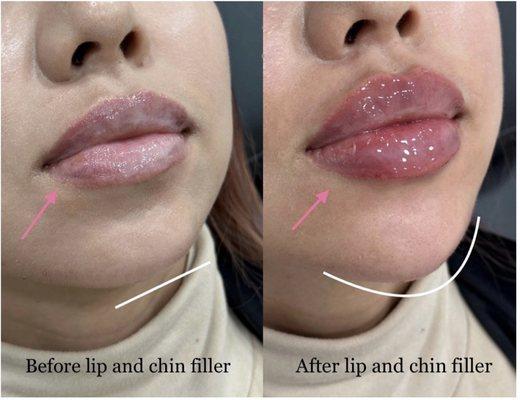 Lip and chin filler, lip flip