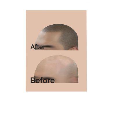 Alopecia smp treatment