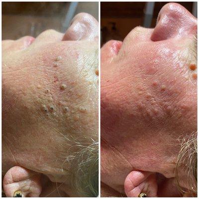 Acne facial with deep extractions. Before and after.