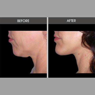 Chin enhancement can sculpt the jawline with minimal incisions thanks to Dr. Antell's specialized techniques.