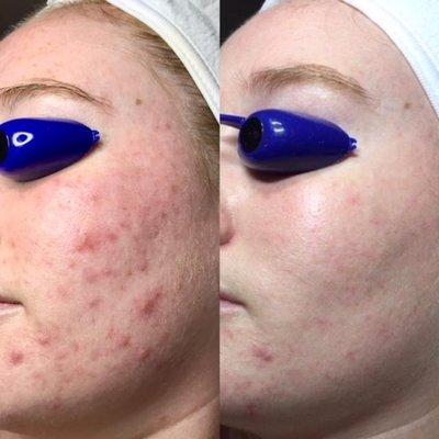 Acne treatments before and after while using acne care products.