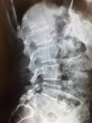 Spondylothesis is a painful condition that gets worse with age