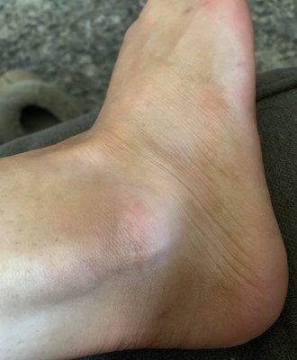 Ankle