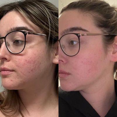 Acne Client Before & After