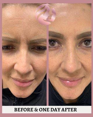 Botox Treatment