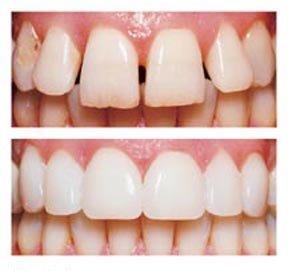 Veneers could be a viable option for you. Ask us how...