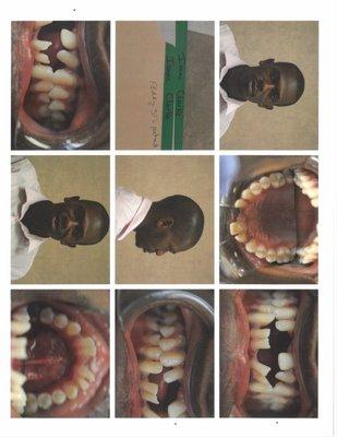 MY DENTAL WORK BEFORE