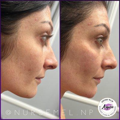 Profile Balancing Cheek & Chin Filler